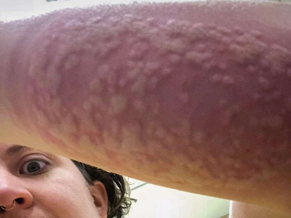 Reid's arm swelling after being bitten by 200 mosquitoes at once in order to be dosed with the experimental malaria vaccine.